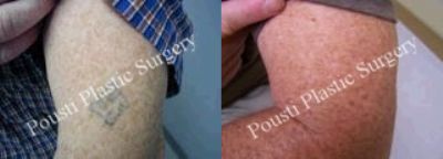  - laser-tattoo-removal-11280-212